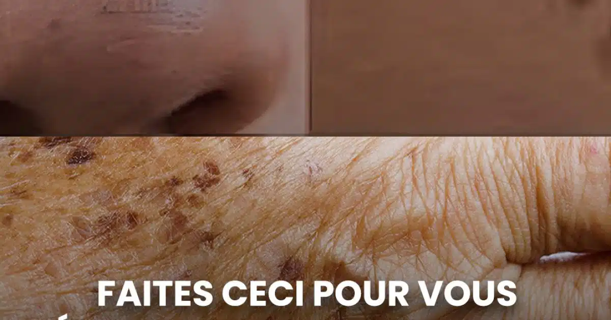 Comment éliminer naturellement les grains de beauté, les verrues, les points noirs, les acrochordons et les taches de vieillesse