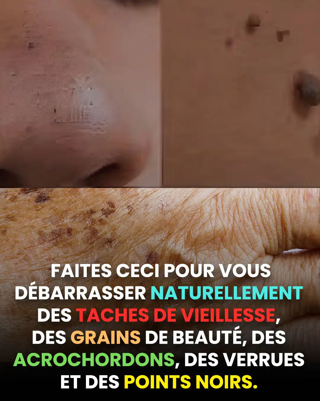 Comment éliminer naturellement les grains de beauté, les verrues, les points noirs, les acrochordons et les taches de vieillesse