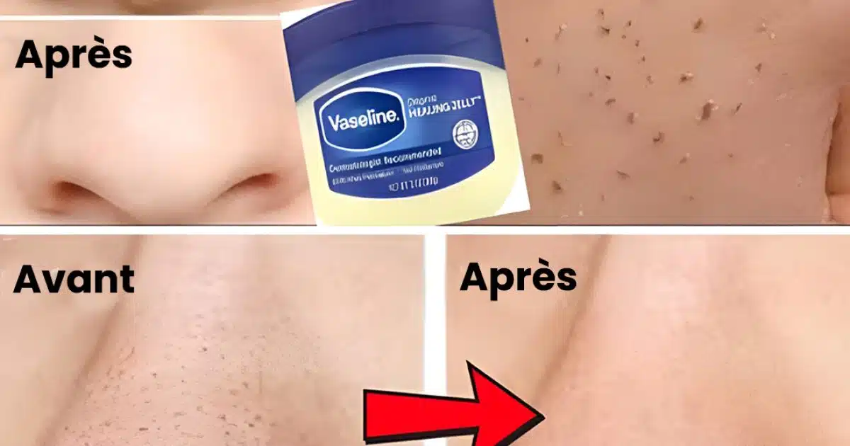 Comment éliminer naturellement les points noirs et blancs du nez et du visage avec de la vaseline