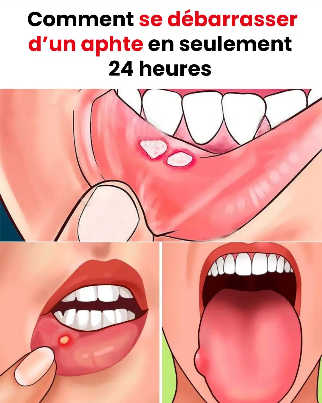 Comment éliminer un aphte en seulement 24 heures