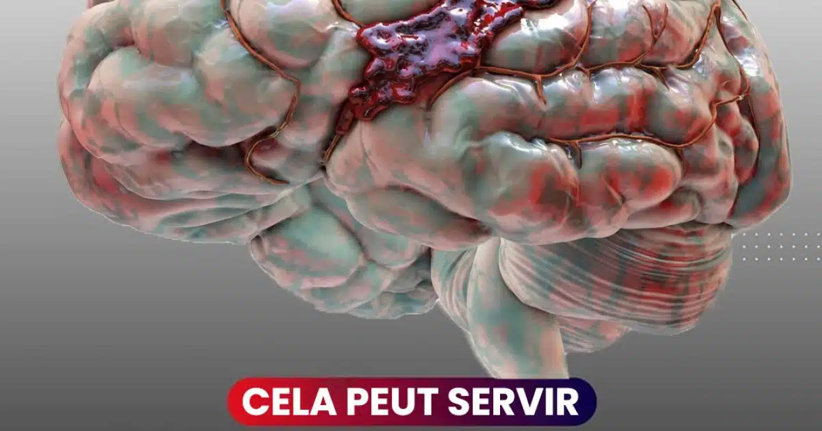 Comment reconnaitre un accident vasculaire cérébral ? (AVC)