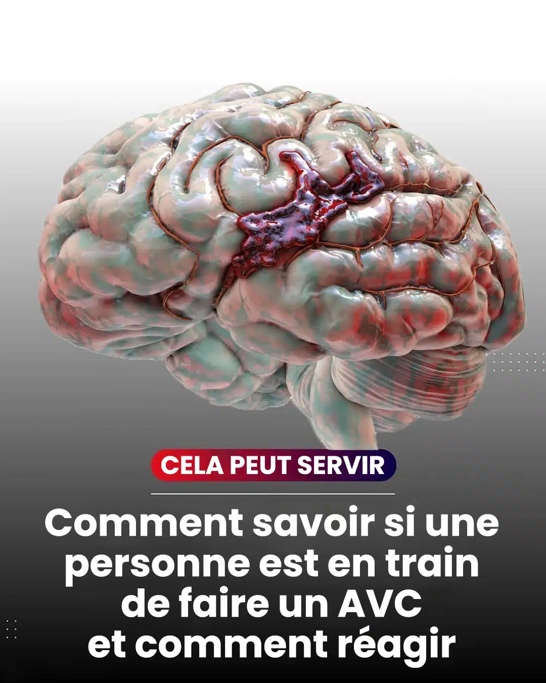Comment reconnaitre un accident vasculaire cérébral ? (AVC)