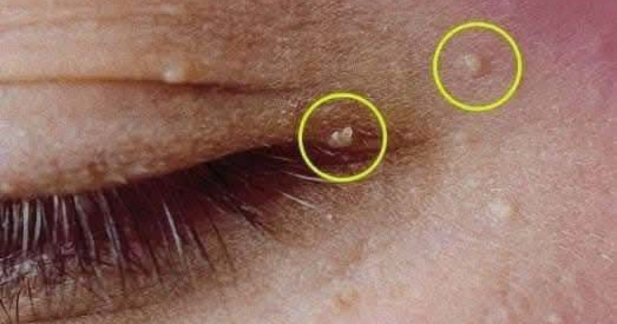 Comment se débarrasser des kystes de milium