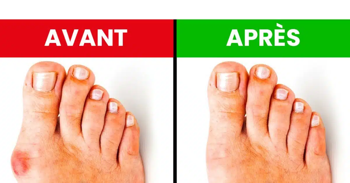 Comment se débarrasser des oignons de pieds ?