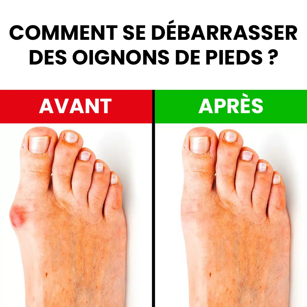 Comment se débarrasser des oignons de pieds ?