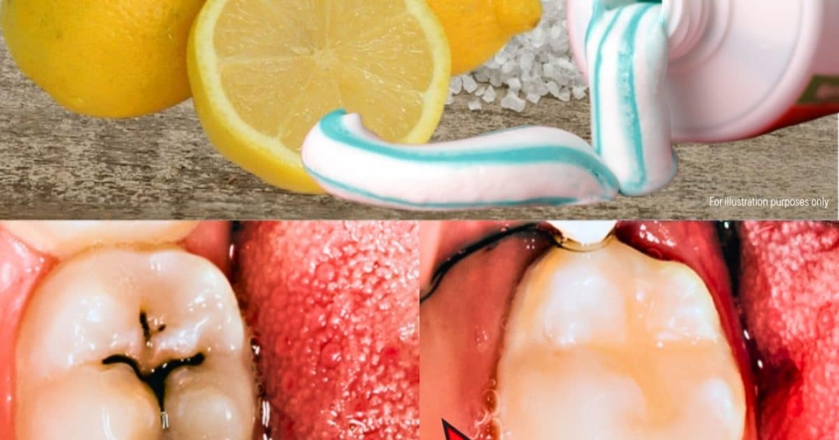Comment soigner une carie naturellement ?