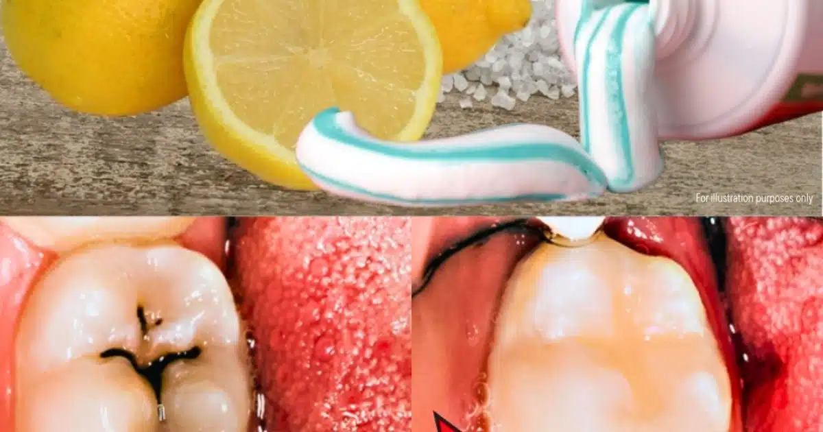 Comment soigner une carie naturellement ?
