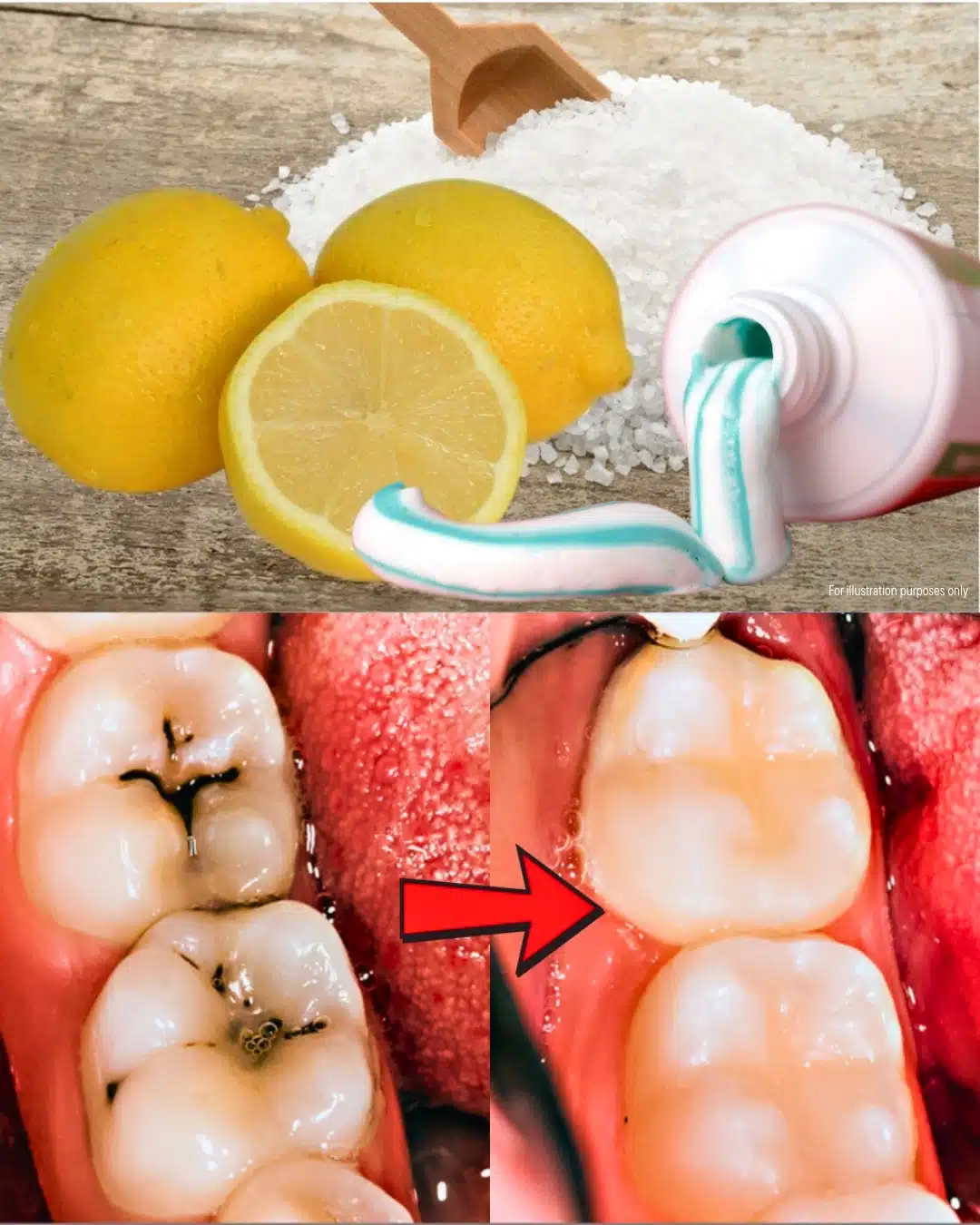 Comment soigner une carie naturellement ?