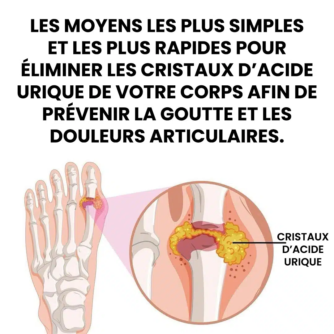 Comment soulager naturellement la goutte et les douleurs articulaires