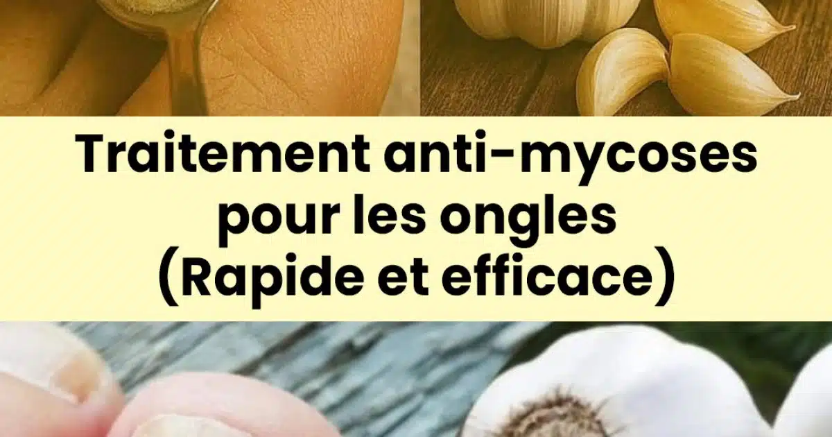 Comment utiliser l’ail pour éliminer les mycoses des ongles ?
