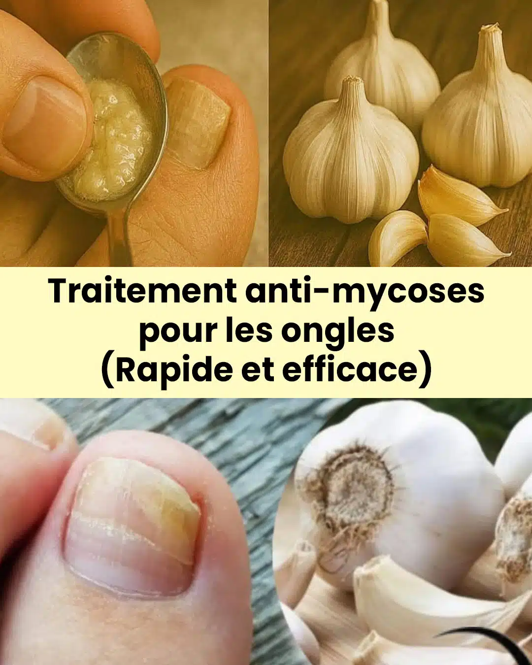 Comment utiliser l’ail pour éliminer les mycoses des ongles ?