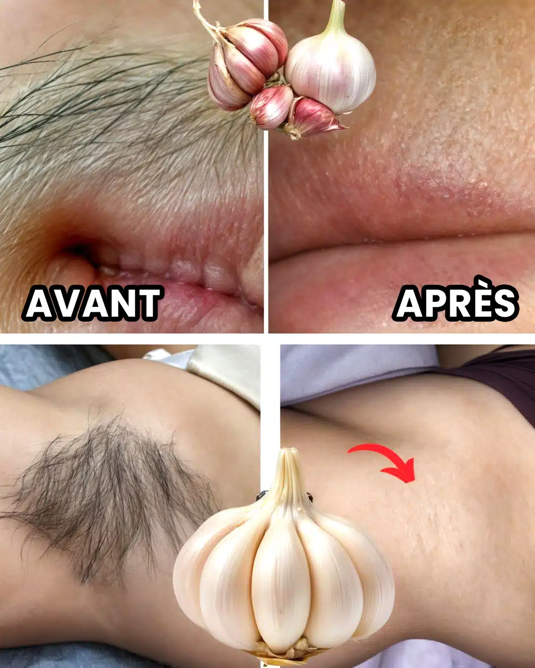 Comment vous débarrasser définitivement des poils du visage et du corps