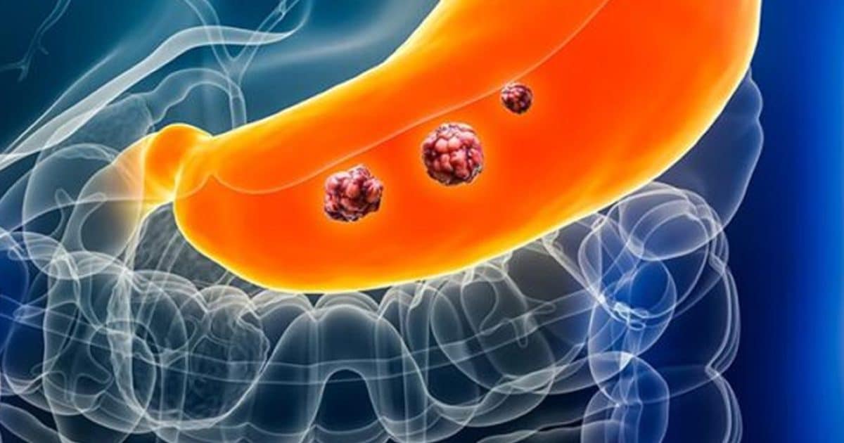 Des experts révèlent le groupe sanguin qui présente le risque le plus élevé de développer un cancer de l'estomac