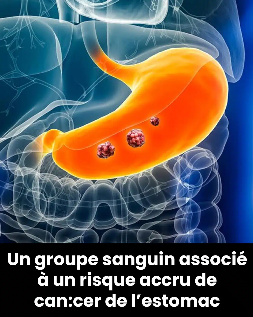 Des experts révèlent le groupe sanguin qui présente le risque le plus élevé de développer un cancer de l'estomac