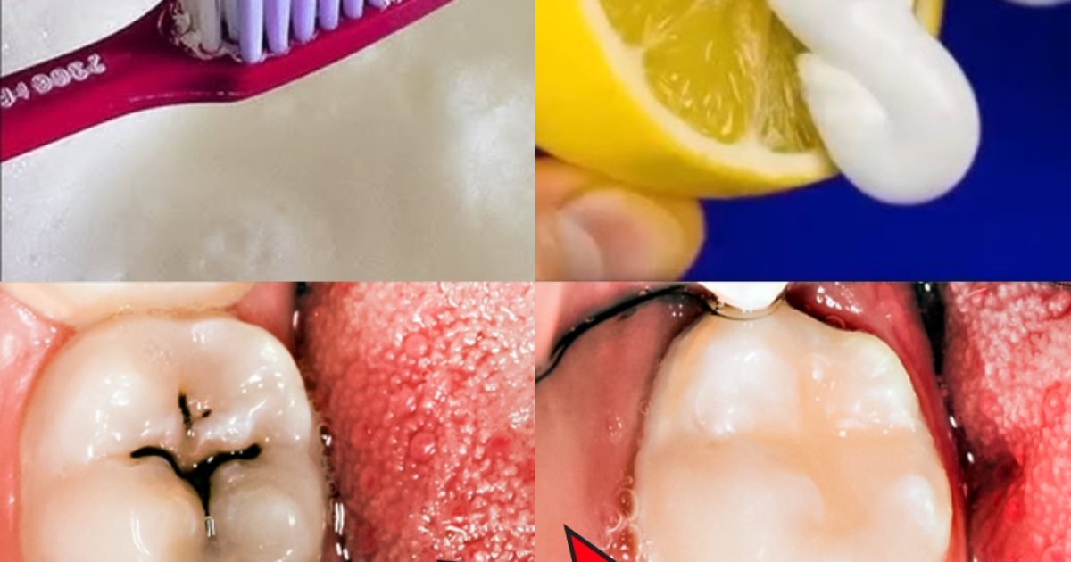 Des moyens naturels pour aider à prévenir les caries et renforcer vos dents