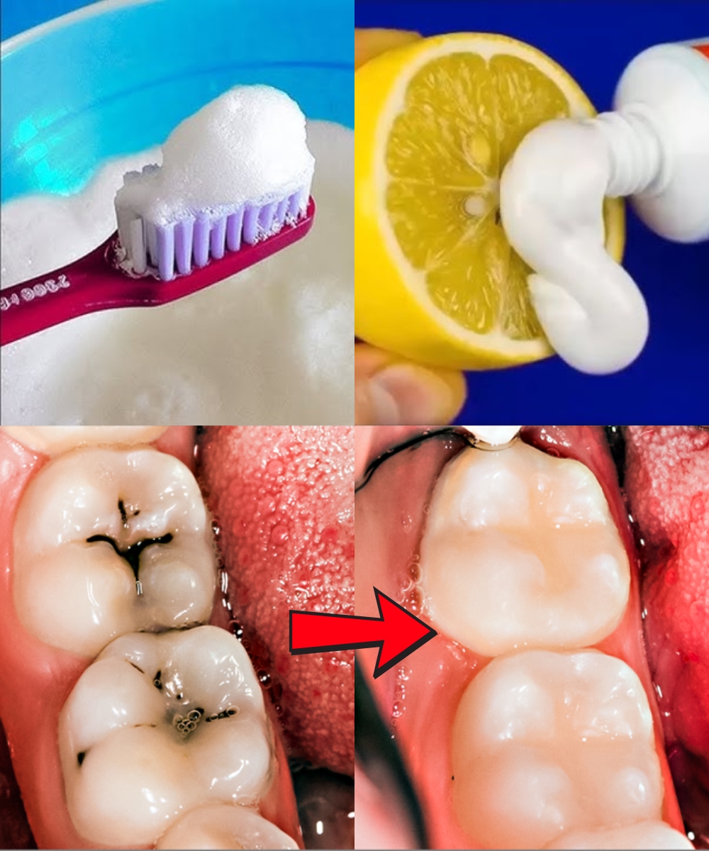 Des moyens naturels pour aider à prévenir les caries et renforcer vos dents
