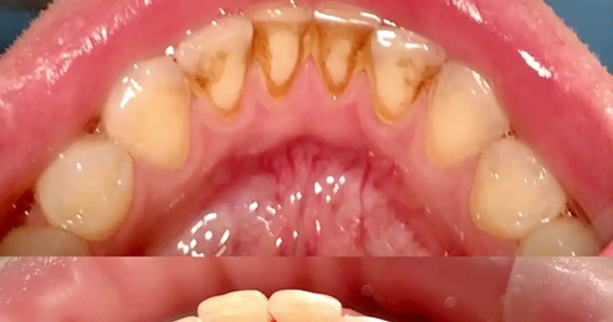 Des remèdes maison pour éliminer le tartre des dents