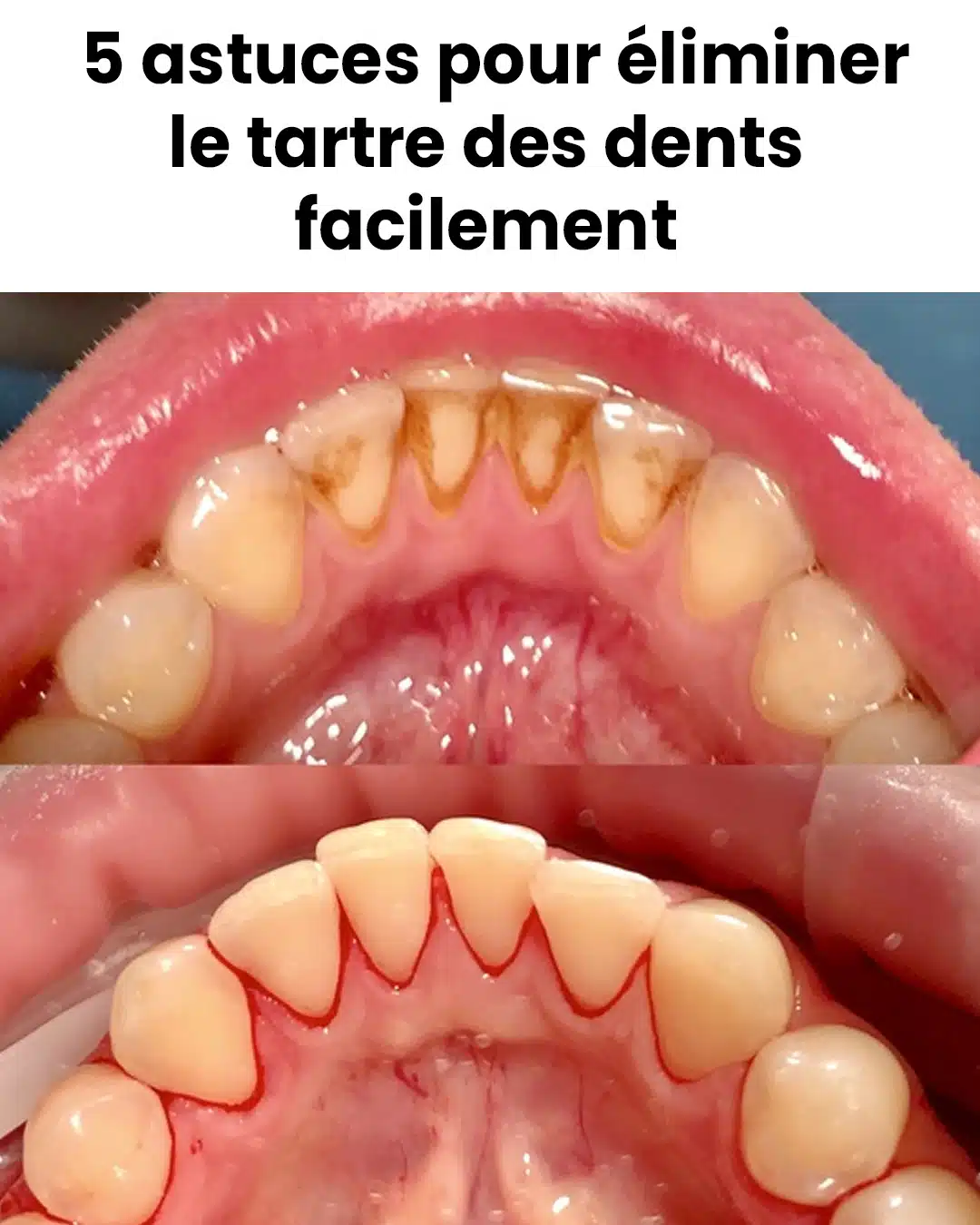 Des remèdes maison pour éliminer le tartre des dents