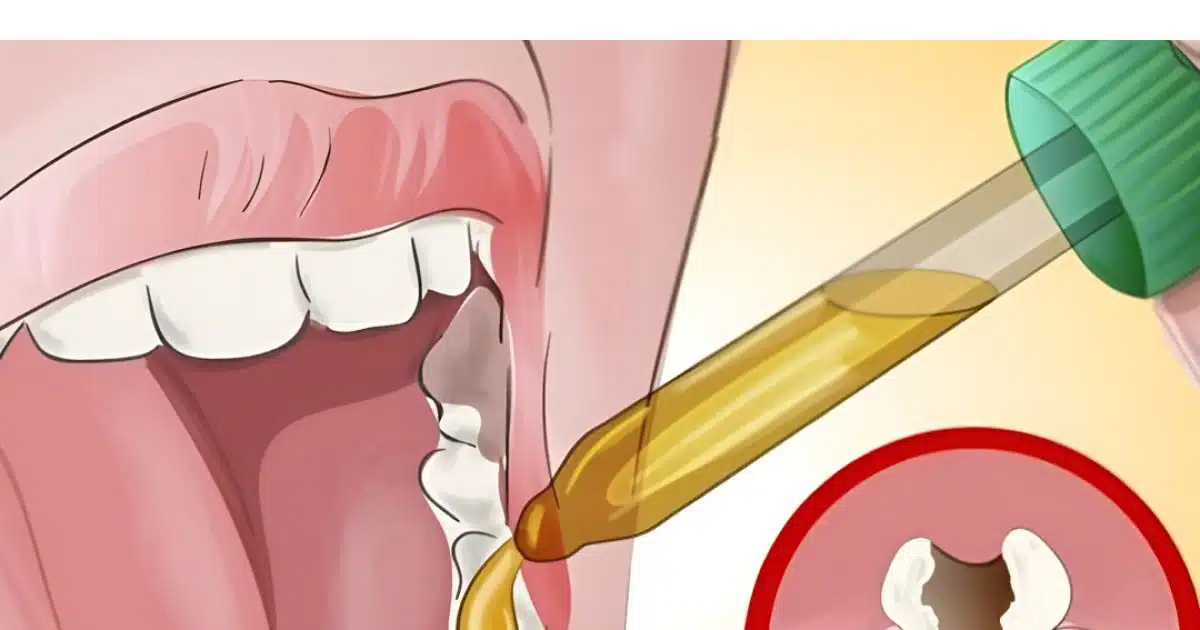 Des remèdes naturels contre le mal de dents