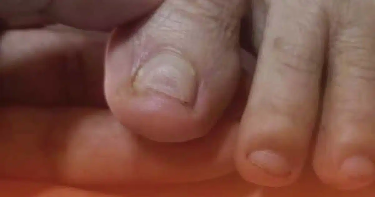 Deux symptômes à identifier sur vos pieds pour prévenir des complications