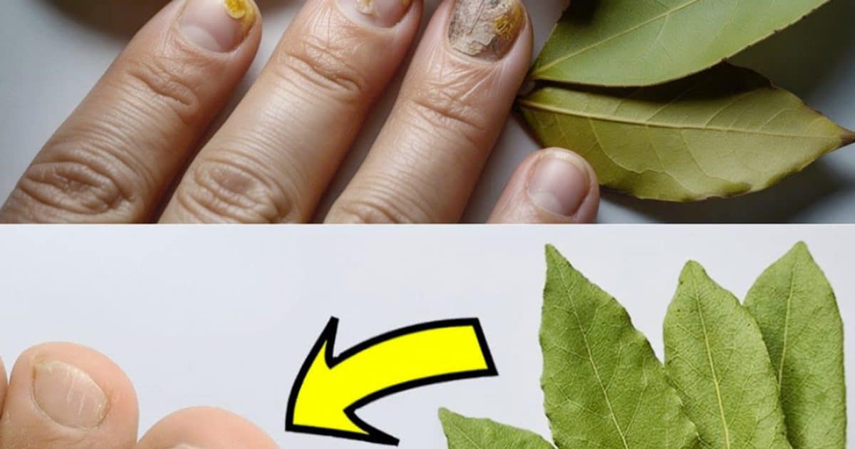 Dites adieu aux champignons des ongles pour moins de 0,50 € ! Un simple remède à base de feuille de laurier qui fonctionne