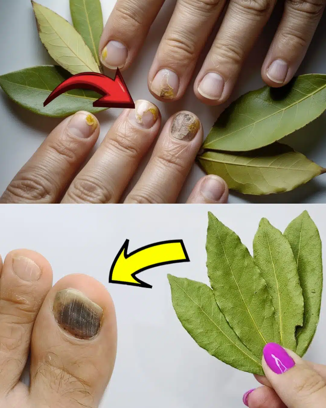 Dites adieu aux champignons des ongles pour moins de 0,50 € ! Un simple remède à base de feuille de laurier qui fonctionne