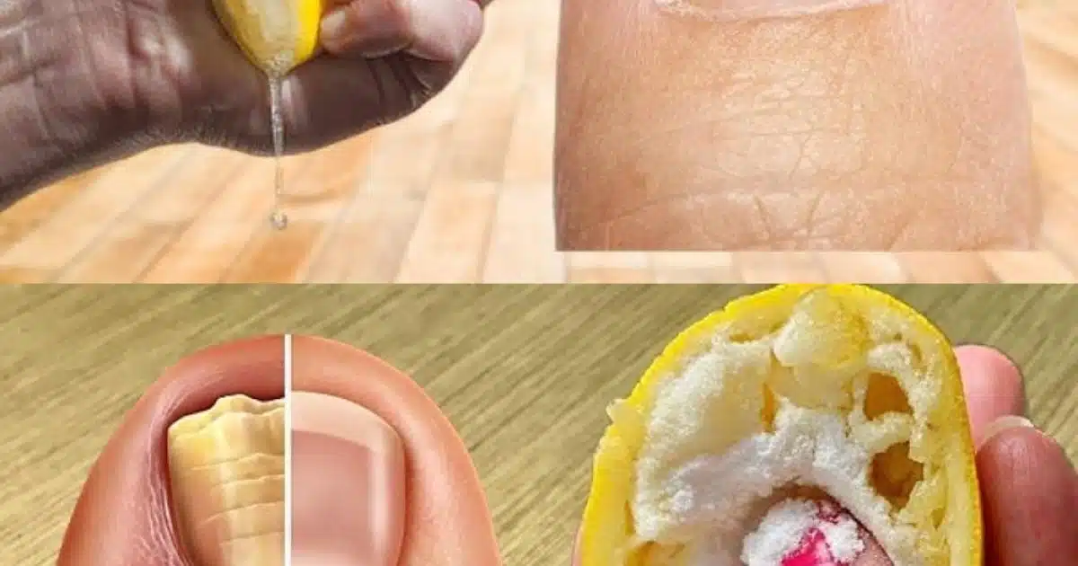 Dites adieu aux mycoses tenaces des ongles des pieds grâce à ce remède naturel
