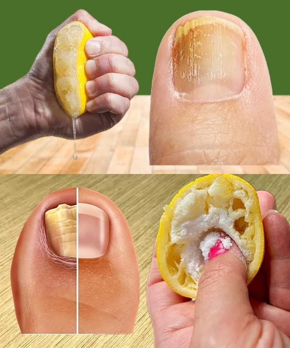 Dites adieu aux mycoses tenaces des ongles des pieds grâce à ce remède naturel
