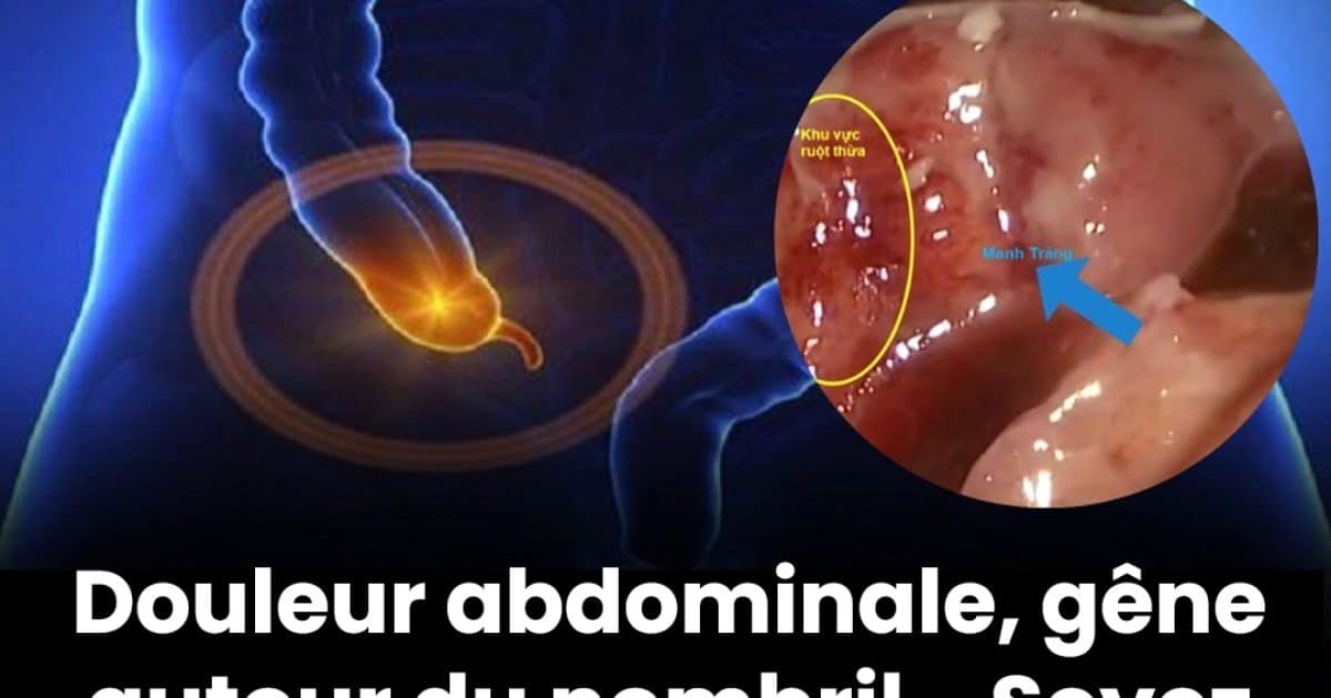 Douleurs abdominales sourdes, douleurs abdominales autour du nombril ? Voici ce qu’il faut savoir