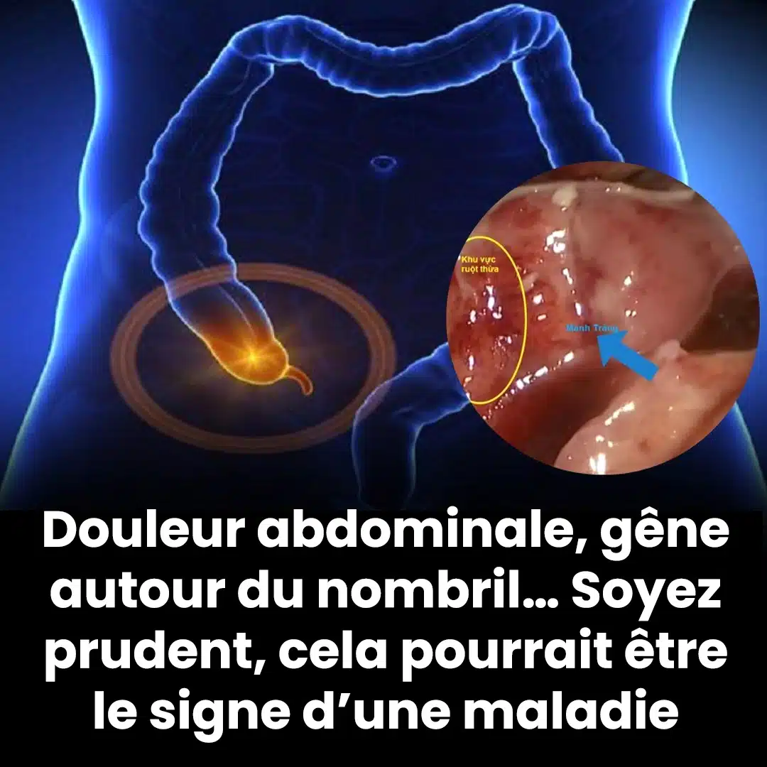 Douleurs abdominales sourdes, douleurs abdominales autour du nombril ? Voici ce qu’il faut savoir