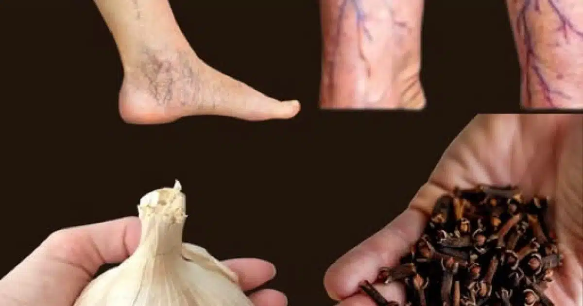 Douleurs aux jambes, rhumatismes, varices, arthrite ? Voici un remède naturel aux clous de girofle et à l'ail