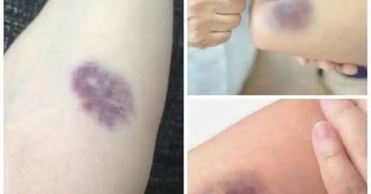 Ecchymoses inexpliquées ? Voici ce que votre corps essaie peut-être de vous dire