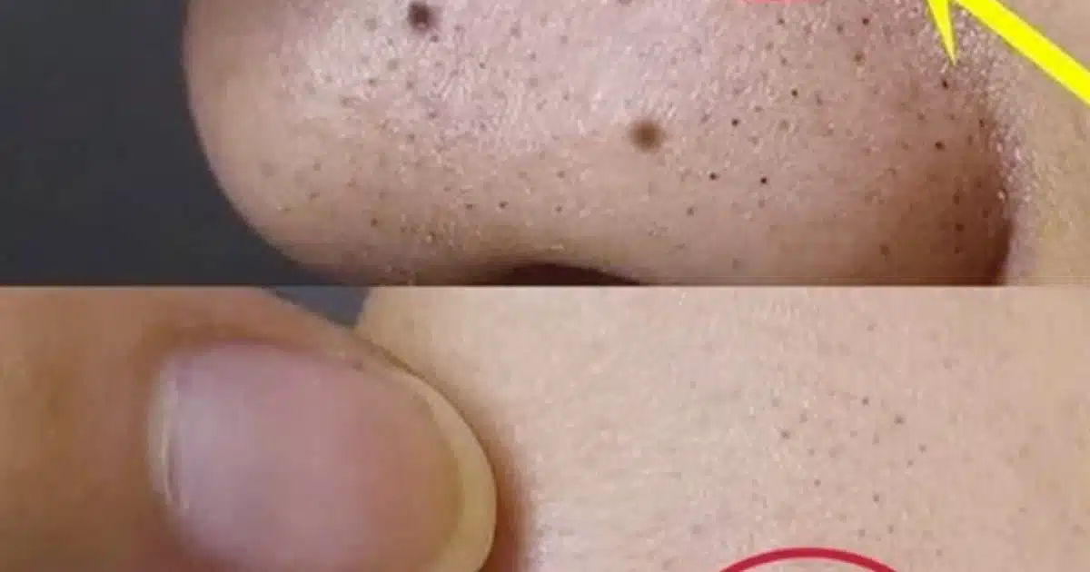Éliminez les grains de beauté, les verrues, les points noirs, les acrochordons et les taches de vieillesse naturellement