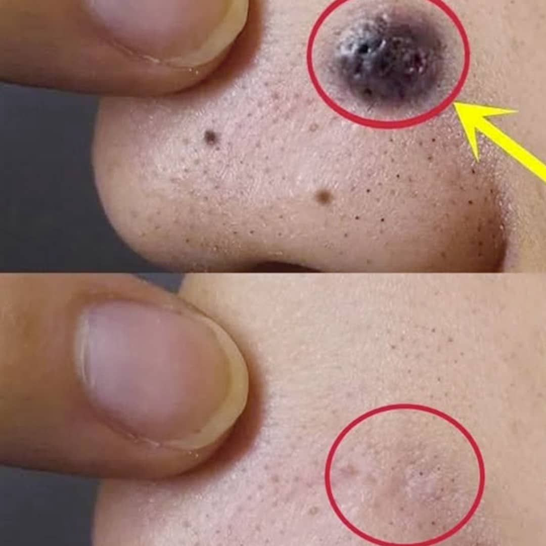 Éliminez les grains de beauté, les verrues, les points noirs, les acrochordons et les taches de vieillesse naturellement