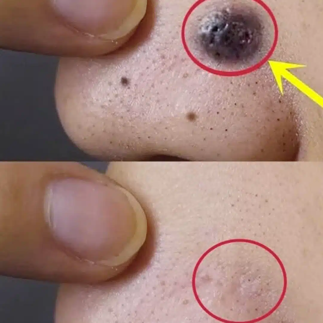Éliminez les grains de beauté, les verrues, les points noirs, les acrochordons et les taches de vieillesse naturellement