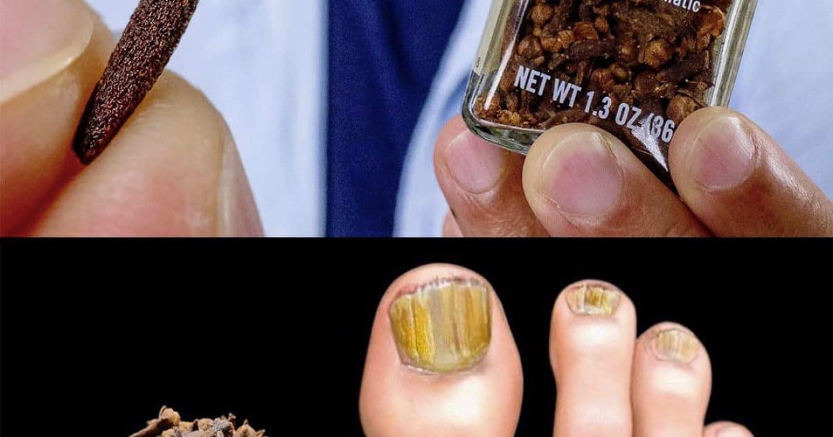 Éliminez les mycoses des ongles naturellement