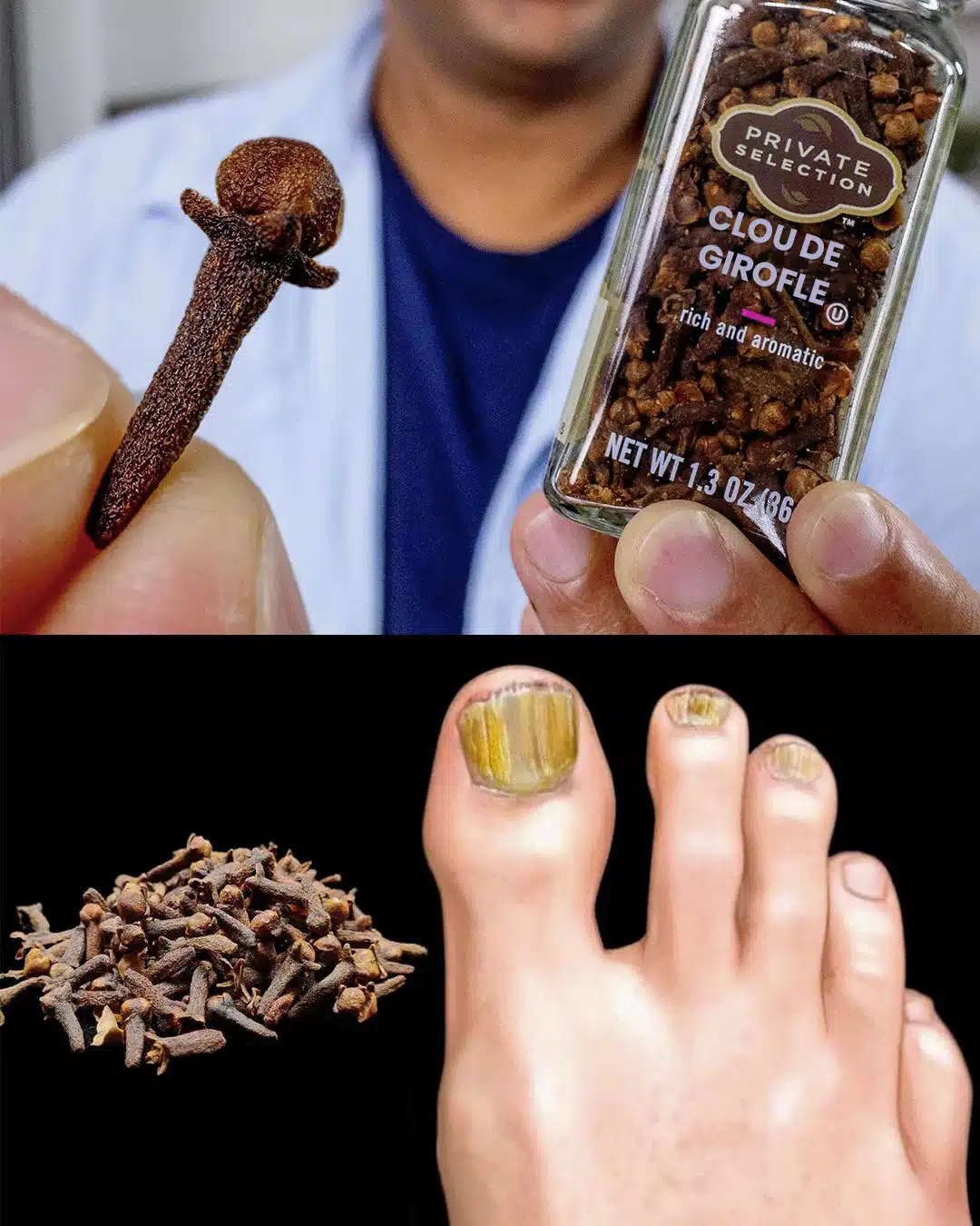 Éliminez les mycoses des ongles naturellement