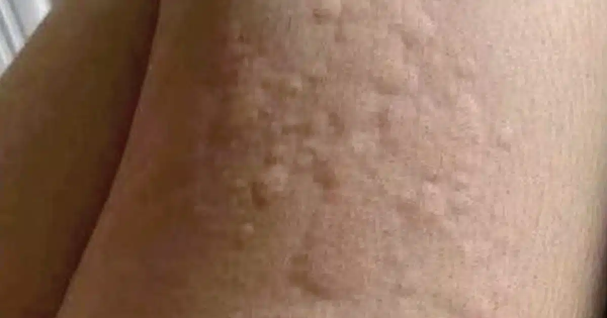 Et si ces plaques rouges qui grattent cachaient autre chose ?