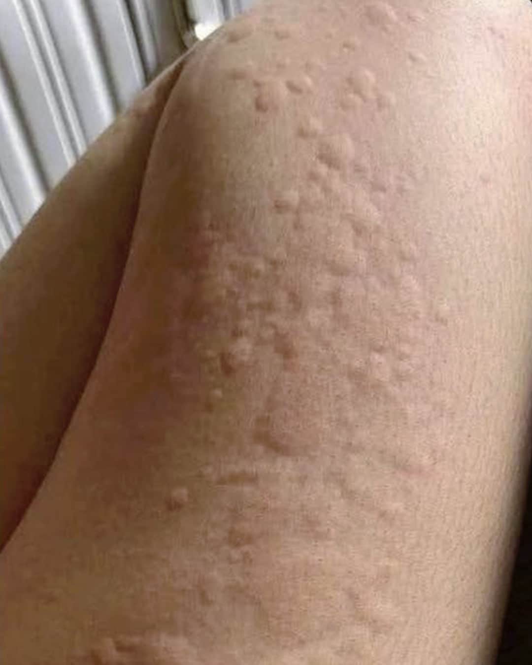 Et si ces plaques rouges qui grattent cachaient autre chose ?