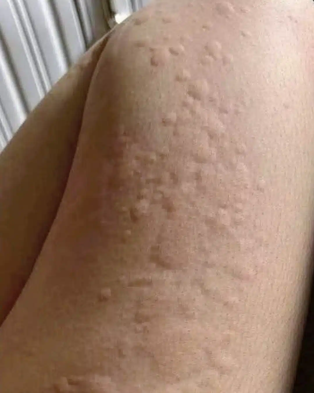 Et si ces plaques rouges qui grattent cachaient autre chose ?