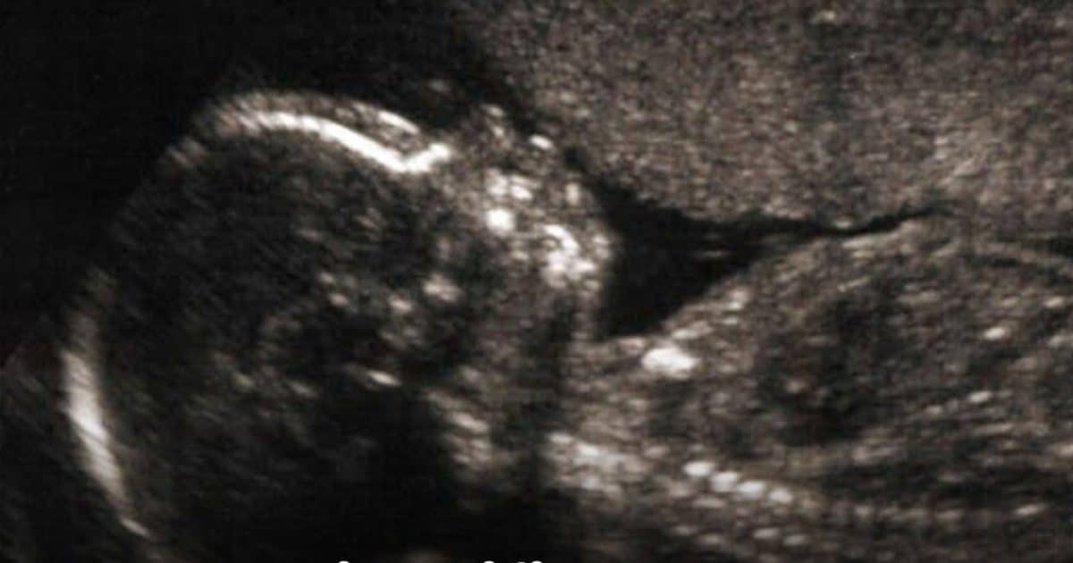 Et si l’autisme laissait une trace invisible dès la naissance ?