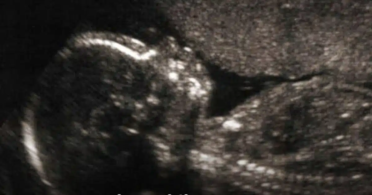 Et si l’autisme laissait une trace invisible dès la naissance ?
