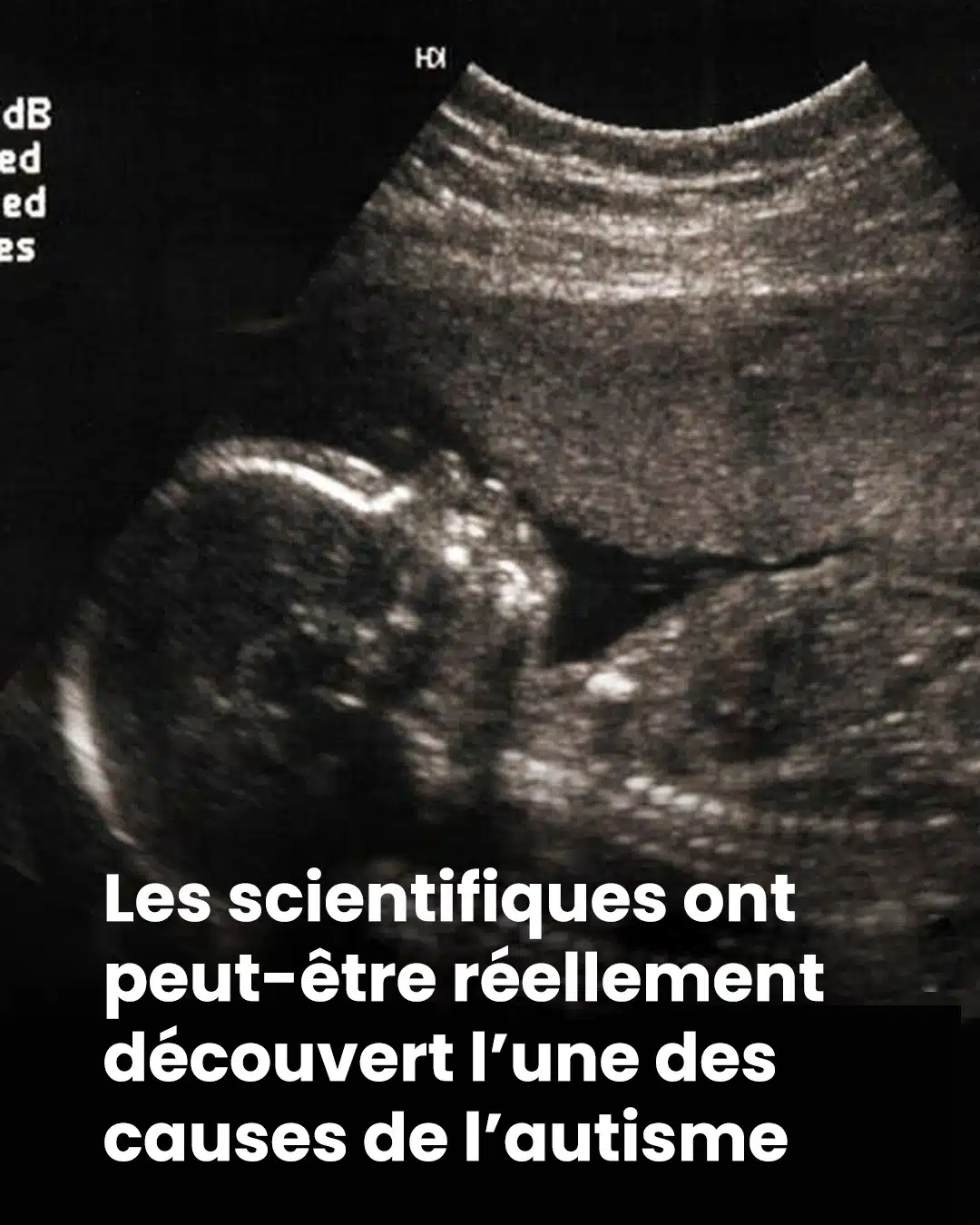 Et si l’autisme laissait une trace invisible dès la naissance ?
