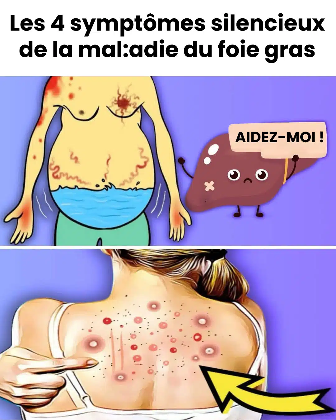 Foie gras : causes, symptômes, traitements et remèdes