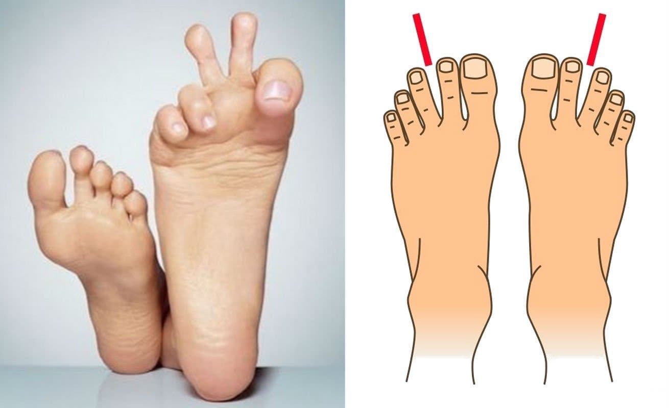 formes de pieds
