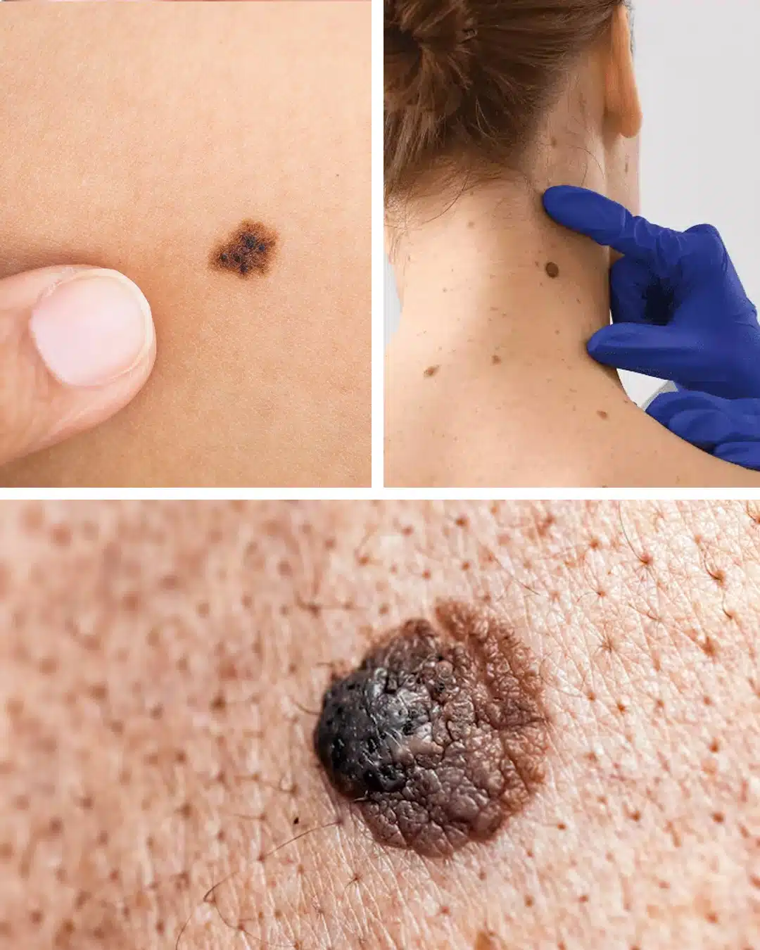 Grain de beauté sur la peau : quelles significations ?