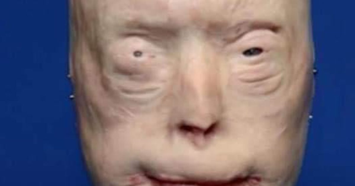 Il a reçu un nouveau visage après des brûlures au troisième degré