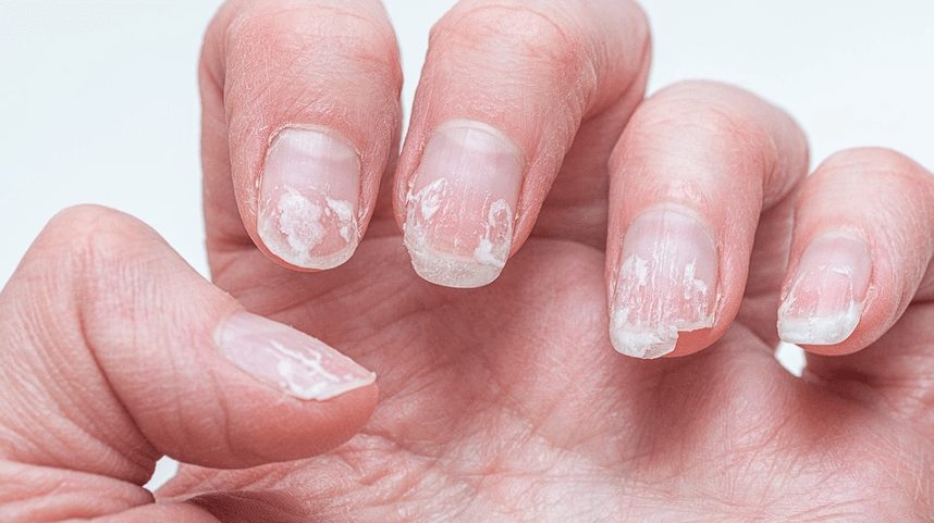 Ongles cassants et dédoublés