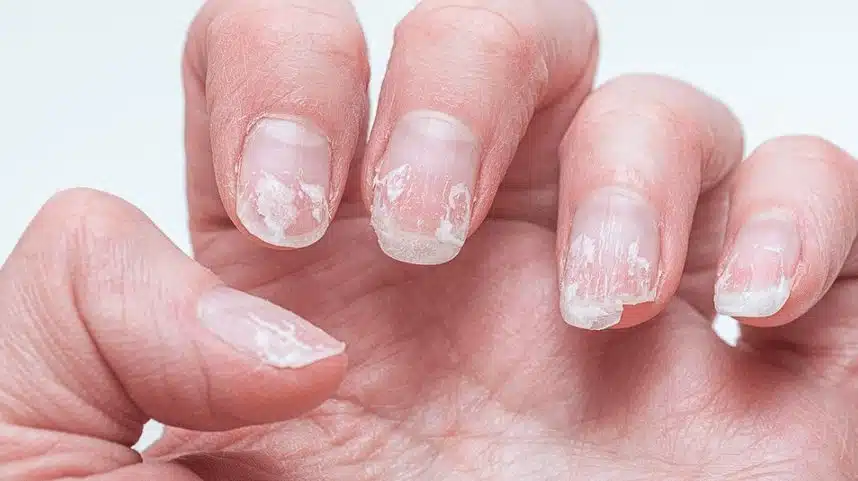 Ongles cassants et dédoublés