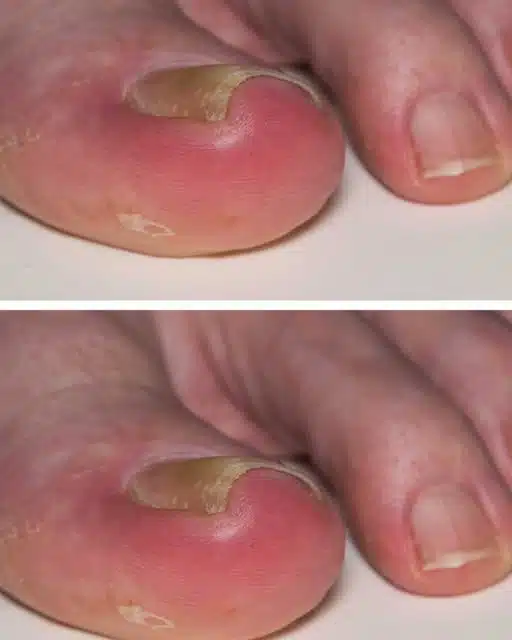 J'ai des rougeurs et des douleurs sur les bords de mes ongles de pieds. Que puis-je faire ?